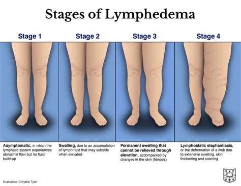 Lymphedema: Pictures, Symptoms, Causes, and Treatment